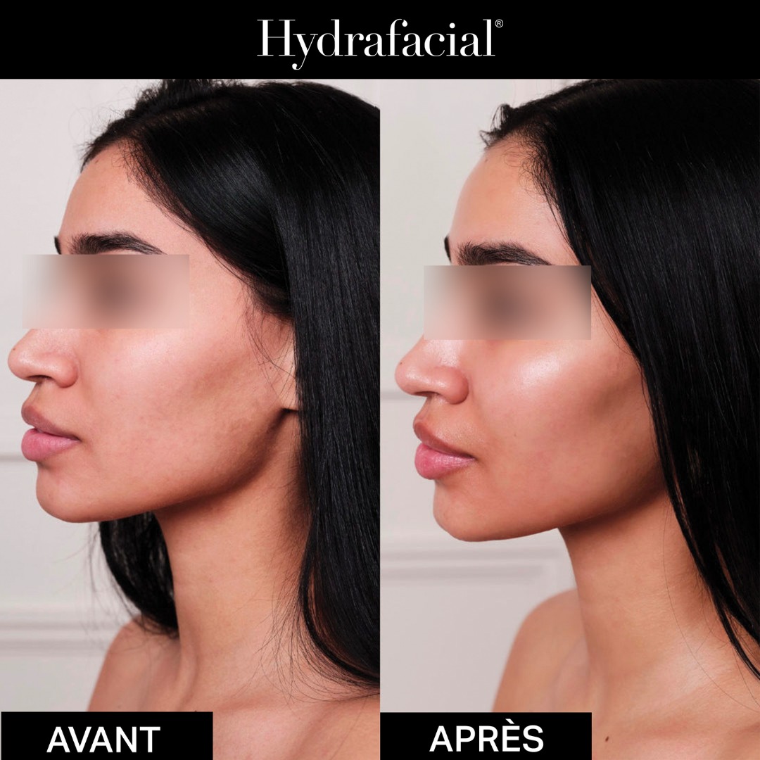 ✨ Avant / Après Hydrafacial : le glow immédiat signé Institut C ✨
Vous hésitez encore à tester l’Hydrafacial ?
Voici ce que votre peau pourrait vivre en une seule séance
Avant : teint terne, pores visibles, texture irrégulière.
Après : peau repulpée, lumineuse, fraîche… un véritable effet “peau neuve” 💧
Un protocole complet en 3 étapes :
1. Nettoyage + exfoliation douce
2. Aspiration des impuretés
3. Infusion d’actifs hydratants et antioxydants
Le soin chouchou de nos patientes avant un événement, en cure ou juste pour se sentir belle au naturel.
📍 Institut C – Lyon
📞 06 86 16 85 71
📅 Réservez votre glow sur Planity : Lien dans la bio.
#institutclyon #hydrafacialavantapres #glowup #peauradieuse #effetbonneMine #soinvisage #peauneuve #glowinstantané #lyonbeaute #beauteenconfiance #hydrafacial