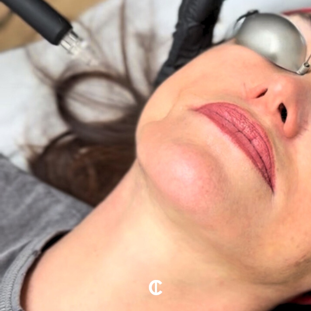 Zaffiro — le soin combiné pour lifter, raffermir et densifier votre peau sans injection
Vous rêvez d’un visage plus tonique, d’une peau raffermie et d’un éclat naturel ?
Découvrez le Zaffiro, un soin innovant qui associe :
💧 Water peeling pour exfolier en douceur
🌡️ Infrarouge pour un effet thermolift stimulant le collagène
✔️ Résultat : une peau plus dense, un ovale redessiné, un teint lissé et lumineux… dès la première séance !
📖 En savoir plus dans notre article : Lien dans la bio.
🌸 Offrez à votre peau un vrai coup de jeunesse, sans aiguille.
📍 Institut C – Lyon
📞 06 86 16 85 71
#institutclyon #zaffiro #waterpeeling #infrarouge #liftingnaturel #raffermissement #soinvisage #antiage #glowup #medecineesthetique #lyonbeaute #peauliftée #eclatnaturel