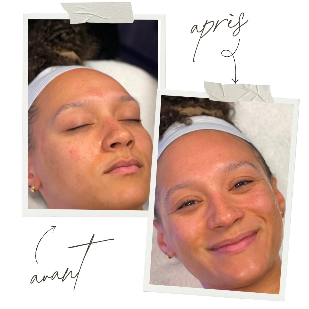 Avant / Après Hydrafacial
Un soin, une transformation.
Grâce à la technologie Hydrafacial, en une seule séance, la peau est :
💧 Nettoyée en profondeur
🧴 Exfoliée en douceur
🌿 Hydratée intensément
🌟 Visiblement plus lumineuse et unifiée
Résultat immédiat :
✔️ Teint éclatant
✔️ Pores resserrés
✔️ Grain de peau affiné
✔️ Effet bonne mine garanti
Et imaginez votre peau après votre propre séance...
📍 Institut C – Lyon
📞 06 86 16 85 71
📅 Réservez sur Planity : Lien dans la bio.
#institutclyon #hydrafaciallyon #avantapres #peauglowy #soinvisage #beauteenprofondeur #lyonbeaute #effetbonneMine #glowupjourney #resultatsvisible