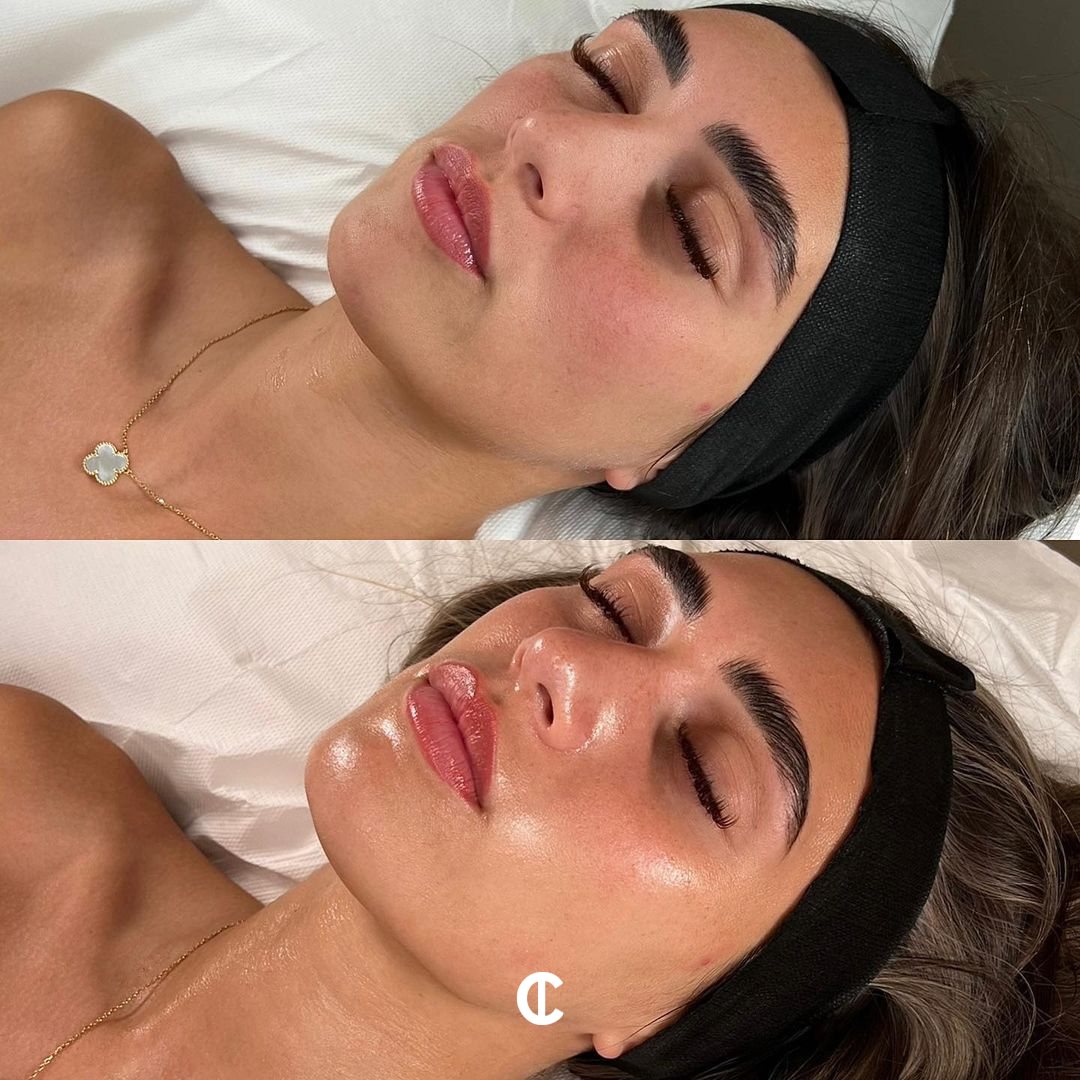 ☀️ Avant / Après Hydrafacial – L’été n’a jamais autant fait briller votre peau !
Avant : teint terne, texture irrégulière, pores visibles
Après : peau lumineuse, lisse, hydratée en profondeur et éclat naturel boosté
💦 Le soin Hydrafacial est votre allié de l’été :
✔️ Nettoyage en profondeur
✔️ Exfoliation douce + extraction des impuretés
✔️ Hydratation intense & glow immédiat
Idéal pour prolonger son bronzage à la rentrée !
📍 Institut C – Lyon
📞 06 86 16 85 71
📅 Réservez votre séance sur Planity : Lien dans la bio.
#institutclyon #hydrafacial #glowete #avantapres #peaulumineuse #teintfrais #summerglow #soinvisage #soindete #lyonbeaute #medecineesthetique