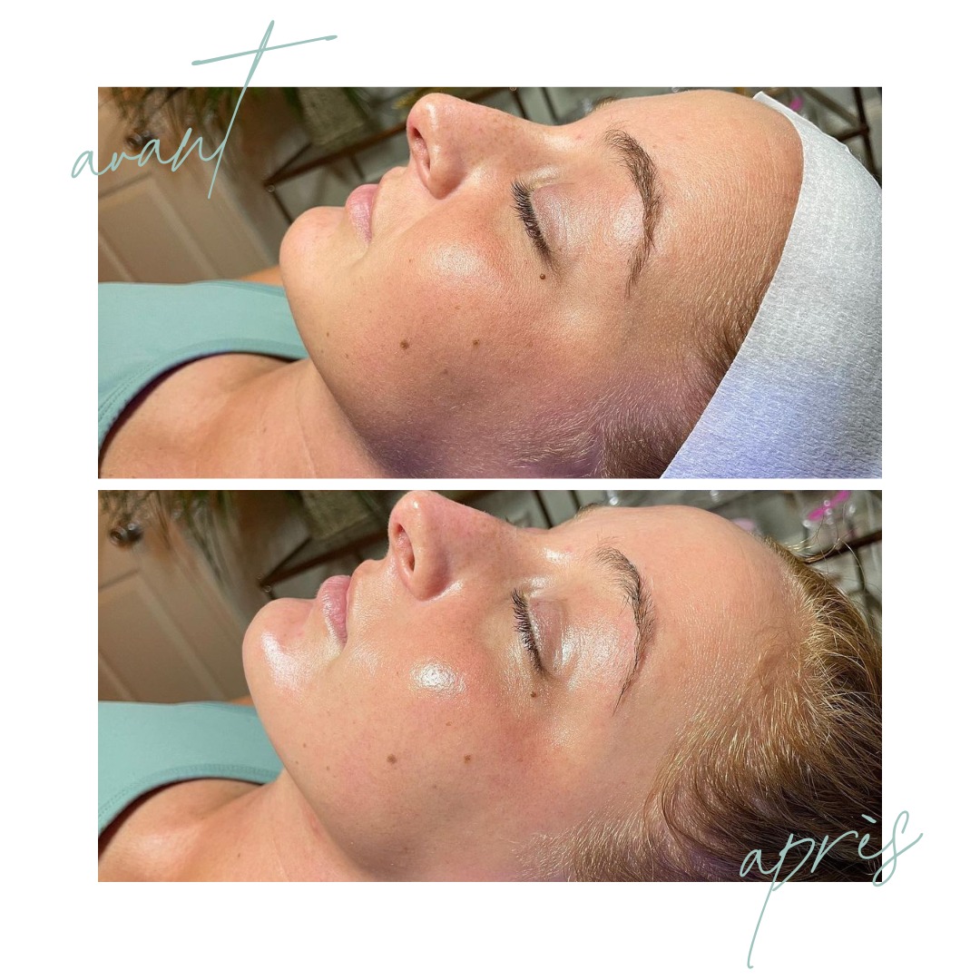 AVANT / APRÈS : le glow incomparable de l’Hydrafacial
Résultat visible dès la première séance :
Avant ➡️ teint terne, pores visibles, texture irrégulière
Après ➡️ peau lumineuse, lisse, fraîche, éclatante !
Le soin préféré des peaux fatiguées ou déshydratées, idéal pour :
💧 Nettoyer en profondeur sans agresser
🌿 Infuser des actifs hydratants, antioxydants et repulpants
🌞 Préparer la peau au soleil et au maquillage
Un vrai reset pour votre peau… avec zéro éviction.
📍 Institut C – Lyon
📞 06 86 16 85 71
📅 Prenez rendez-vous dès maintenant sur Planity : planity.com/institut-c-69002-lyon
#institutclyon #hydrafacial #avantapres #soinvisage #glowup #teinteclatant #hydratationpeau #peauparfaite #lyonbeaute #beauteenconfiance