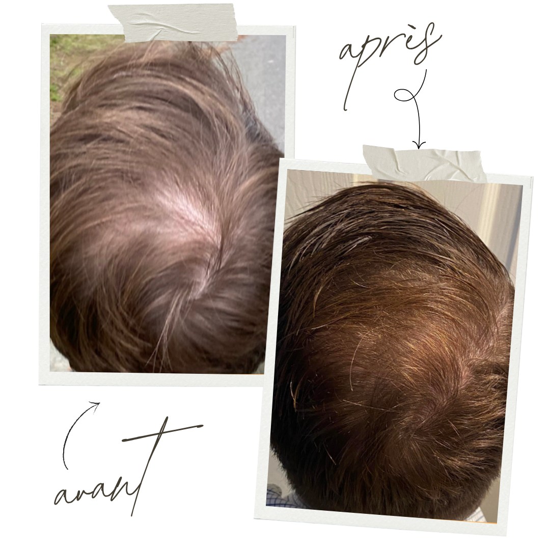 Avant / Après : Hydrafacial Keravive
Parce que la beauté des cheveux commence par un cuir chevelu sain ✨
Le soin Hydrafacial Keravive, c’est :
🌿 Une exfoliation douce du cuir chevelu
💧 Une hydratation profonde
💥 Une stimulation de la circulation pour favoriser la repousse
Résultat après quelques séances :
✔️ Racines purifiées
✔️ Chute de cheveux diminuée
✔️ Cheveux plus forts, plus denses, plus brillants
✔️ Sensation de fraîcheur et de légèreté immédiate
Un protocole idéal en cas de chute, cuir chevelu gras, pellicules ou en préparation d’une greffe capillaire.
📍 Institut C – Lyon
📞 06 86 16 85 71
📅 Réservez sur Planity : Lien dans la bio.
#institutclyon #hydrafacialkeravive #cuirchevelusain #soincheveux #repoussecheveux #keraviveavantapres #soinducuirchevelu #chutecheveux #beautecapillaire #lyonbeaute